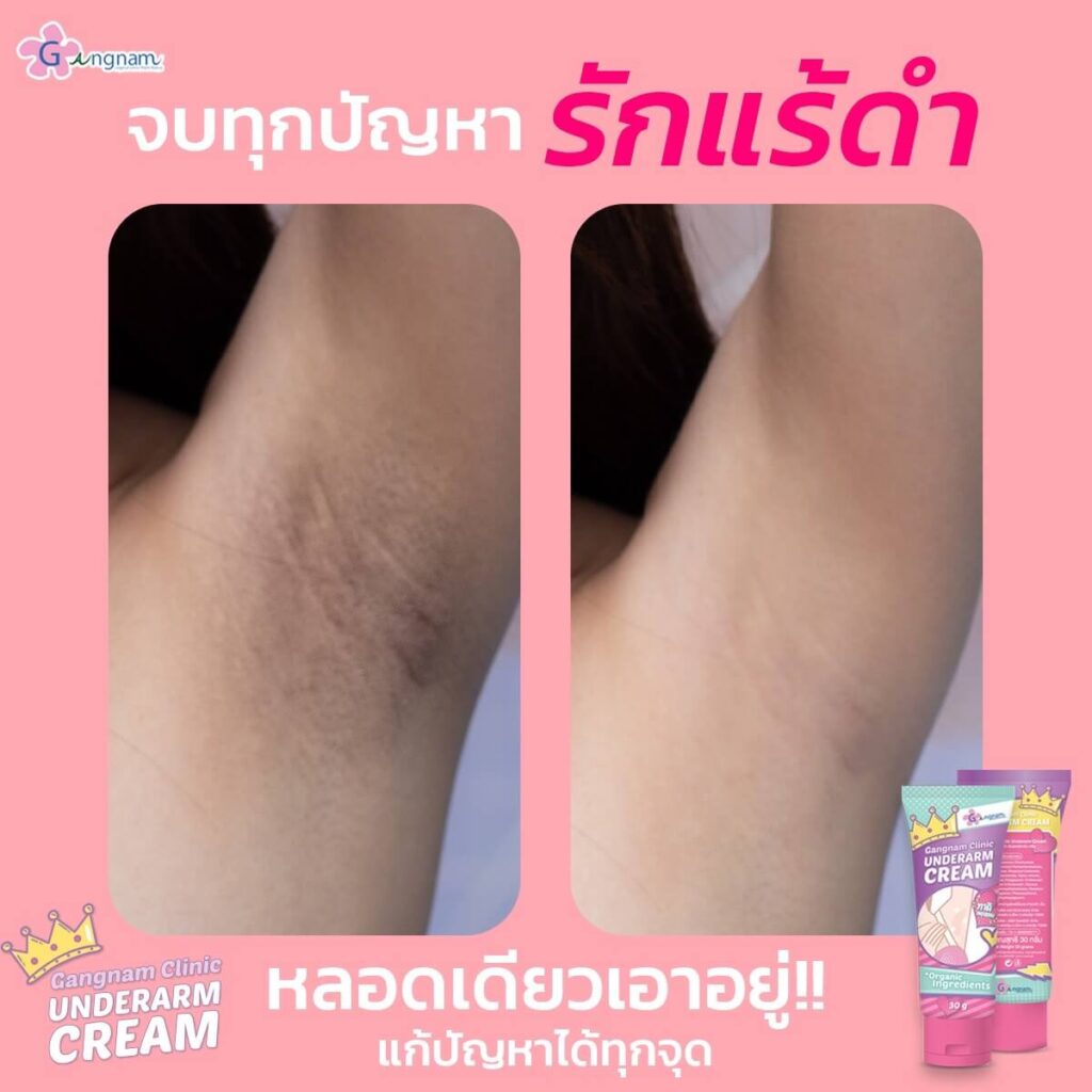 รีวิว ครีมทารักแร้ขาว Gangnam Clinic