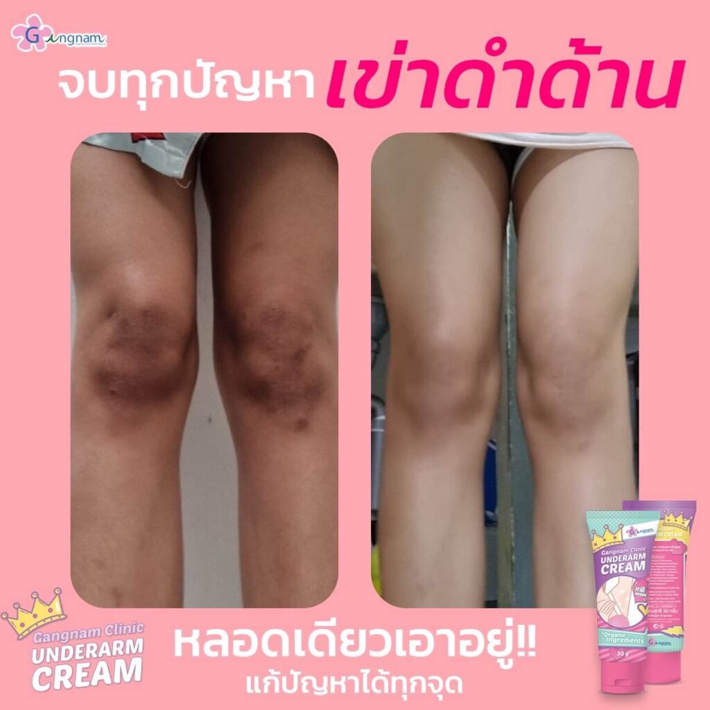 รีวิว ครีมทารักแร้ขาว Gangnam Clinic