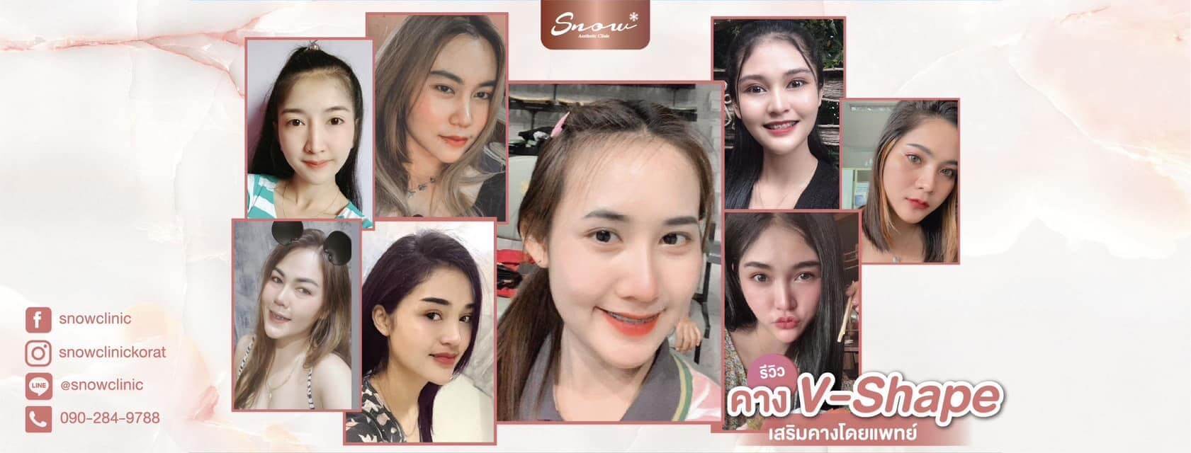 Snow Clinic โคราช โบท็อกซ์ ร้อยไหม ฟิลเลอร์