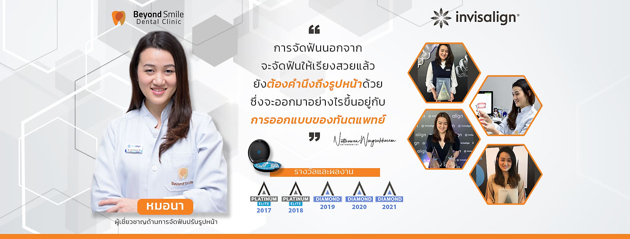 Beyond Smile Dental Clinic วีเนียร์ กรุงเทพ เทคนิคช่วยจัดฟัน ลบร่องรอยการแตก บิ่น หัก ให้ดูจางลง