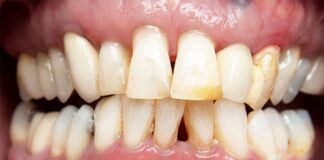 Where is a good place to fix yellow teeth in Bangkok