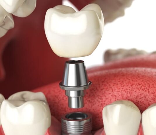 Where is a good place to get implants in Bangkok